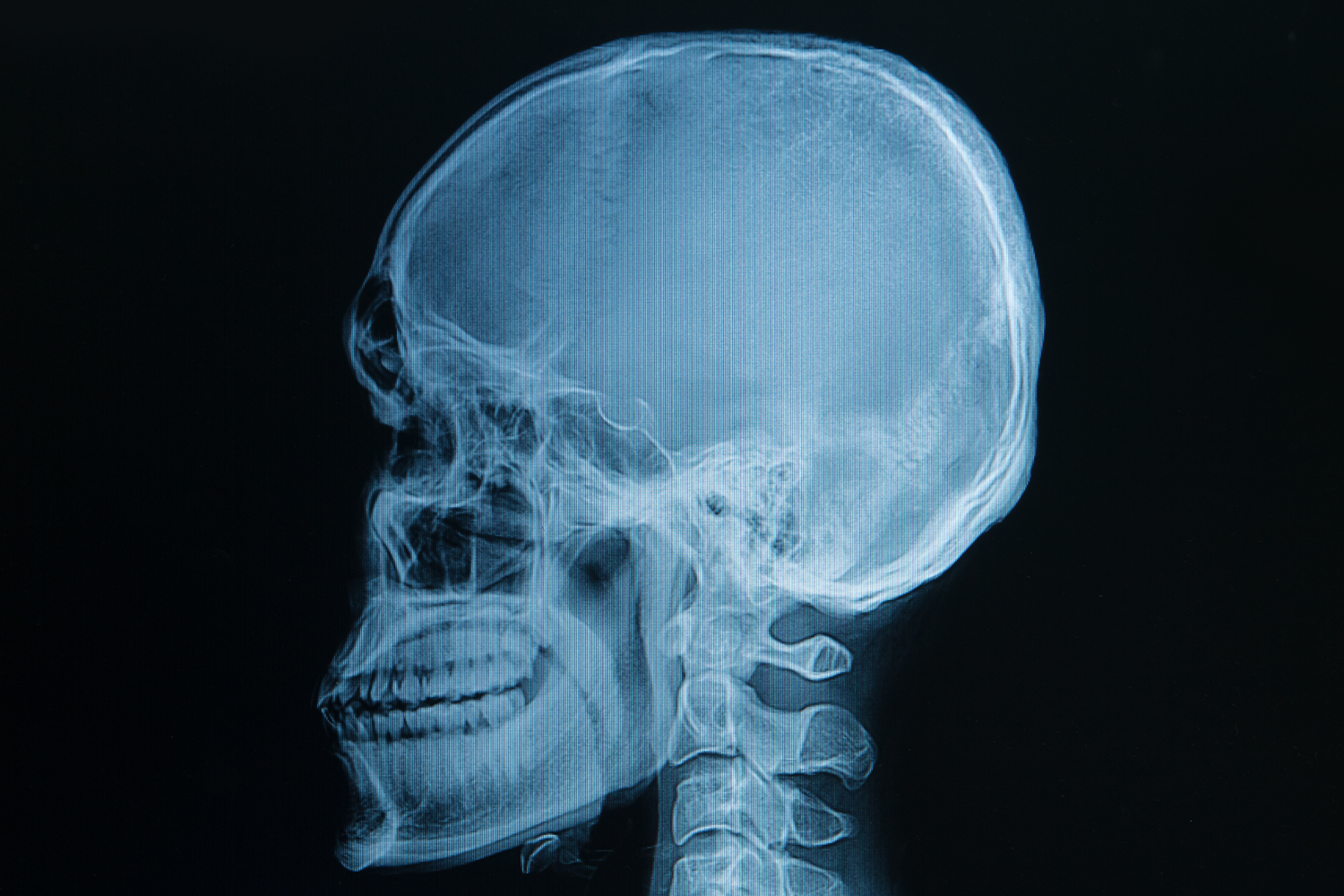 Blunt Force Trauma to the Head: Causes and Effects